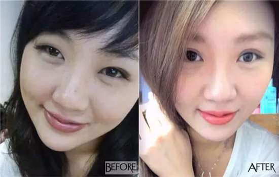 全切双眼皮留疤怎么办 值得收藏的双眼皮手术秘密