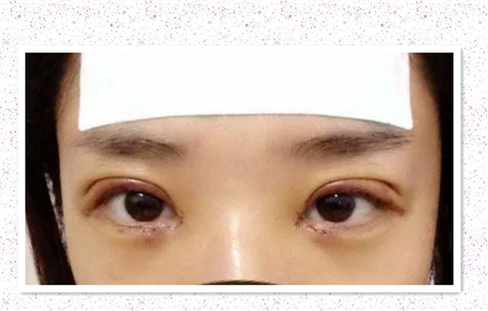 全切双眼皮肉条和肿的区别 你一定要搞清楚这个