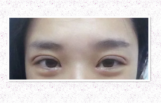 全切双眼皮能吃韭菜吗 值得收藏的术后饮食宝典