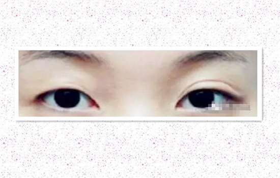 全切双眼皮修复的条件 快看这5个条件你满足吗