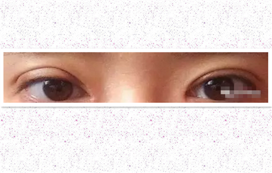 全切双眼皮修复的条件 快看这5个条件你满足吗