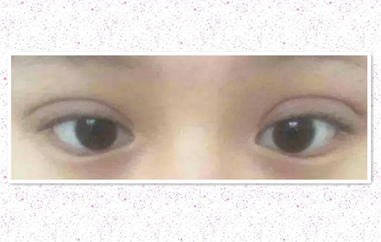 割双眼皮肉条怎么形成的 慎选医生才不会抱憾终生