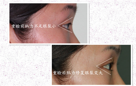 上睑提肌手术有必要吗 只有两类人才有必要做别被忽悠