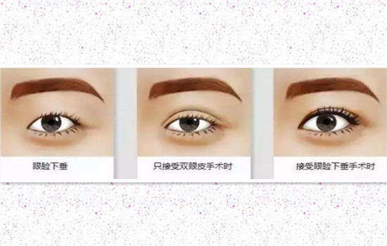 上睑提肌手术有必要吗 只有两类人才有必要做别被忽悠