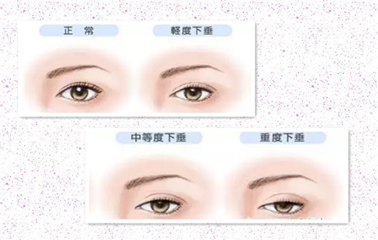 上睑提肌手术有必要吗 只有两类人才有必要做别被忽悠