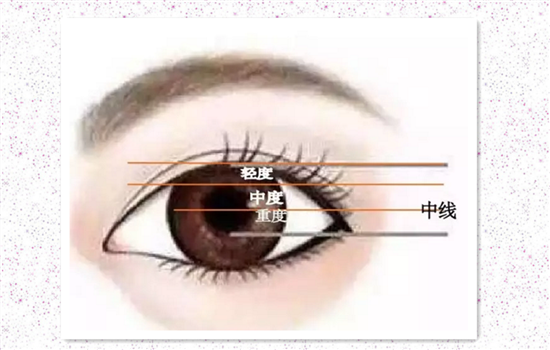 上睑提肌缩短术原理 提肌手术是怎样给你大眼睛的