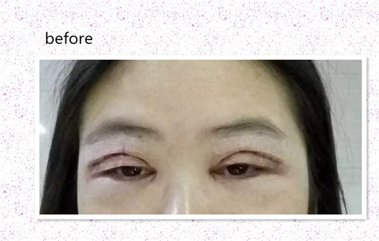 上睑提肌手术缺点 医生不会告诉你的术后并发症