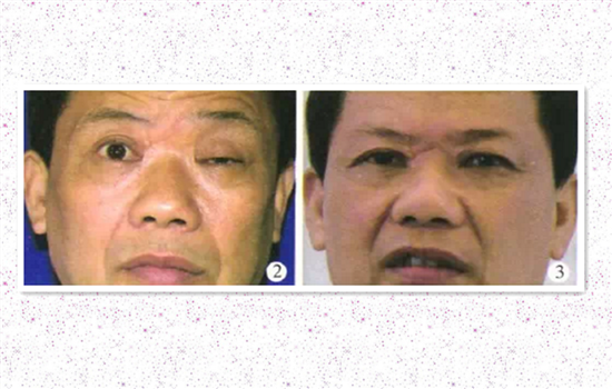 上睑提肌手术怎么做的 双眼皮提肌手术大揭秘