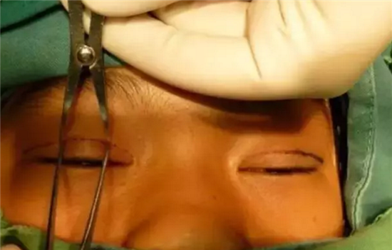 上睑提肌手术怎么做的 双眼皮提肌手术大揭秘