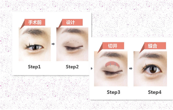 上睑提肌缩短术原理 提肌手术是怎样给你大眼睛的