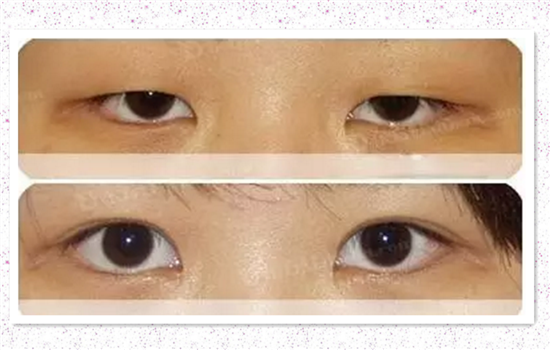 上睑下垂是什么 揭秘哪种上睑下垂需要做手术矫正