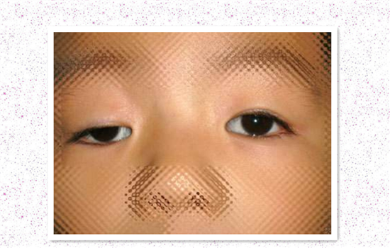 上睑下垂分度标准 看看自己是上睑下垂吗