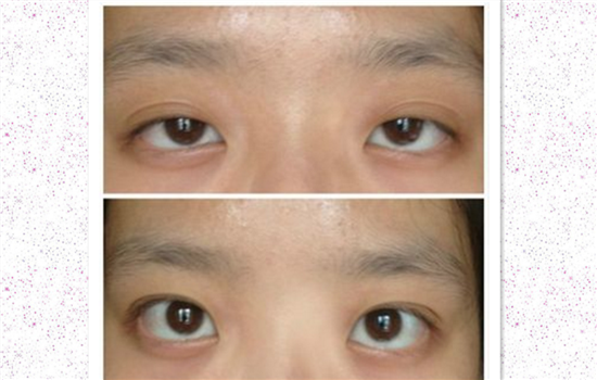 上睑下垂分度标准 看看自己是上睑下垂吗