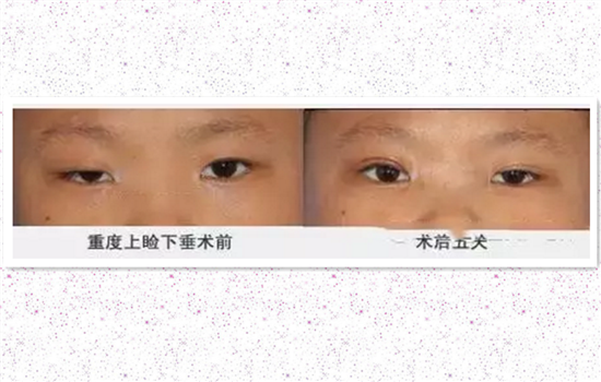 上睑下垂做什么手术 最基本的三种矫正办法你要知道