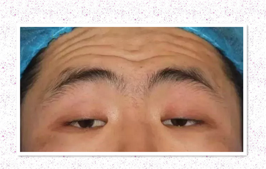 眼睑下垂会影响视力吗 细数上睑下垂的危害