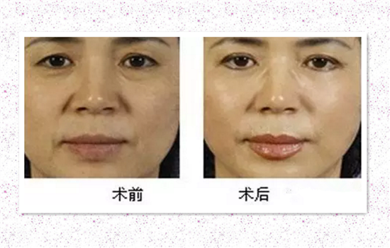 眼睑下垂会影响视力吗 细数上睑下垂的危害