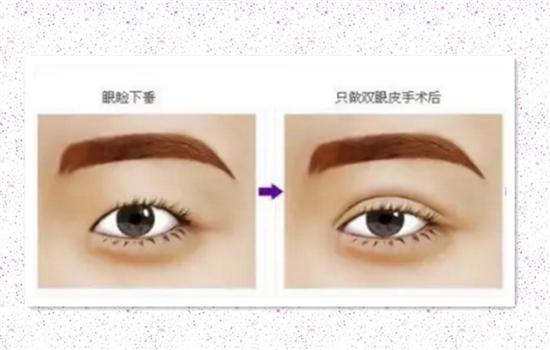上睑下垂可以不手术吗 揭秘眼睑下垂不手术会怎样