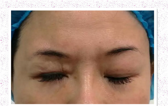 眼睑下垂手术失败图片 第三张不是真的吧