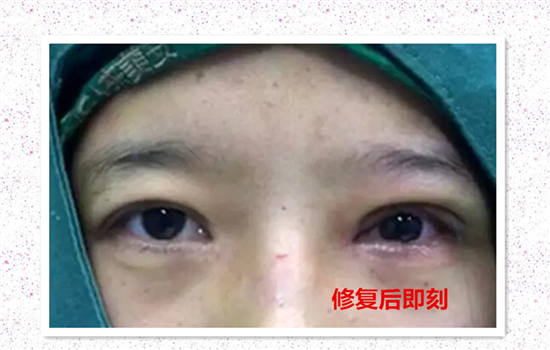 上脸下垂如何自己矫正 平常没事可以多注意做这几件事