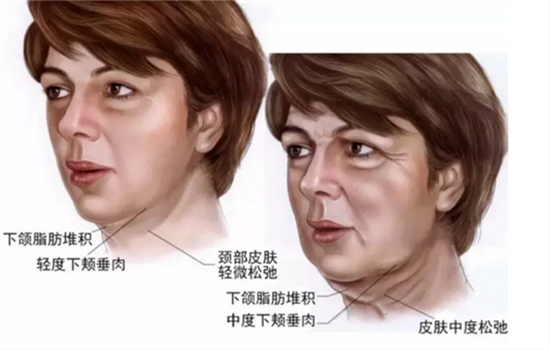 小v线和大v线哪个好看 根据自身条件出发来选择最好