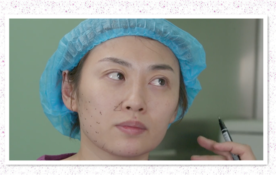 小v线提升操作图 素人体验有图有真相