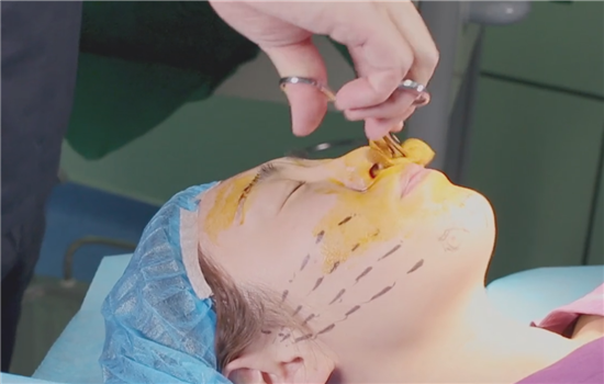 小v线提升操作图 素人体验有图有真相