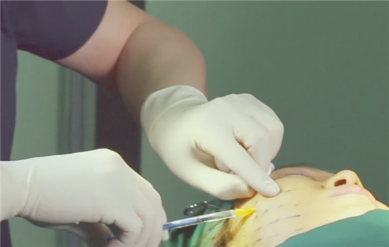 小v线提升操作图 素人体验有图有真相