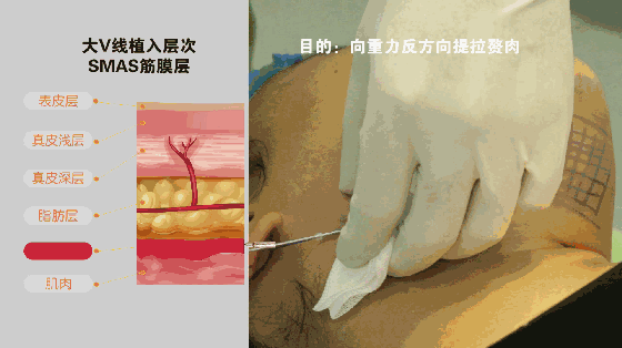 小v线提升操作图 素人体验有图有真相