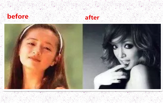 开外眼角和眼睑下至的区别 手术前一定要弄明白的事