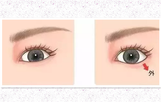 开外眼角和眼睑下至的区别 手术前一定要弄明白的事