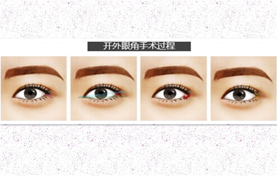 外眼角开了2mm有效果么 一般人没必要去受这个苦