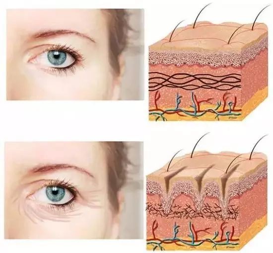 自体脂肪填充面部凹陷 面部凹陷的女人为什么会显老?