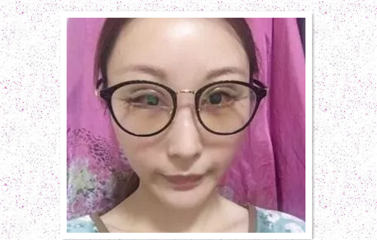 开外眼角5毫米恢复过程 达人亲历有图有真相