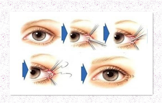 开外眼角5毫米恢复过程 达人亲历有图有真相
