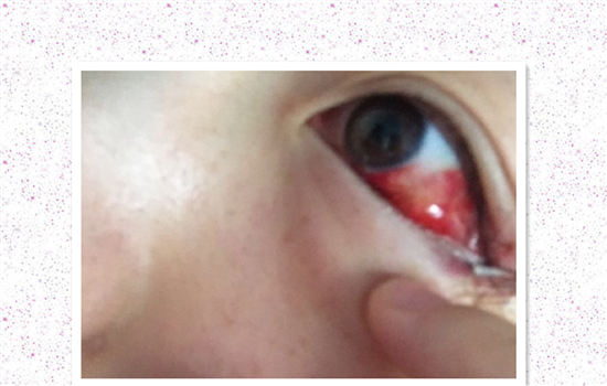 开外眼角的危害 开外眼角面临的4大风险你知道几个