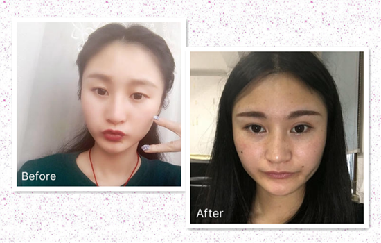 开外眼角前后对比照 五组真人手术前后照片