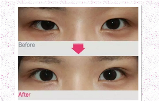 开外眼角怎么开 详解外眦开大术7部曲
