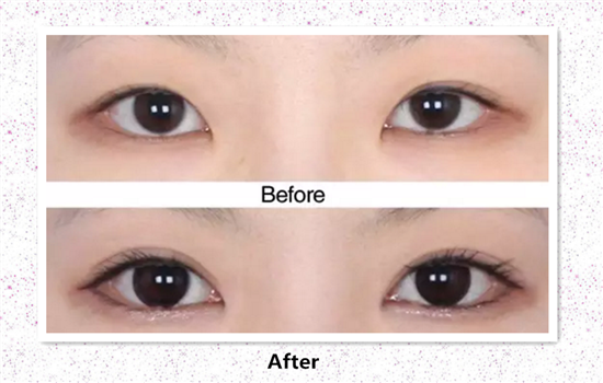 开内眼角的作用 内眦开大的4大好处你知道几个