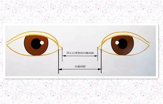 开内眼角的作用 内眦开大的4大好处你知道几个
