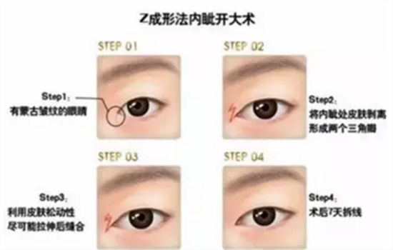 开内眼角有几种方法 值得有眼整形需求的你收藏
