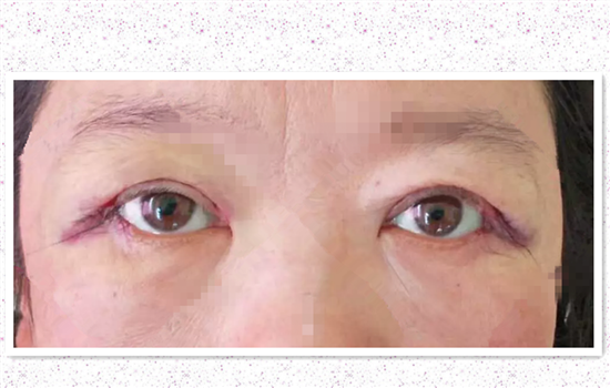 开外眼角后悔了 5位受术者告诉你为什么会后悔
