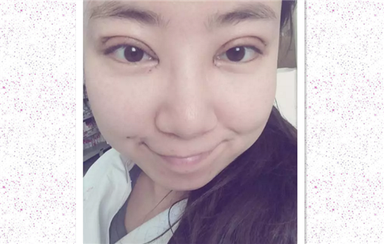 开内眼角七天拆线图片 内眦开大术初期恢复有图有真相