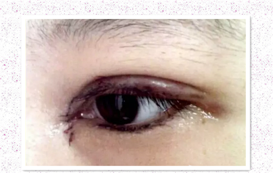 开内眼角好不好 内眦开大术前必须知道的秘密