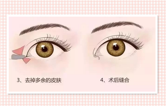 开内眼角好不好 内眦开大术前必须知道的秘密
