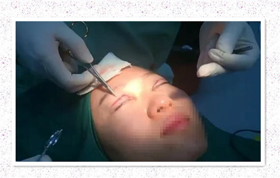 开内眼角手术过程 真人手术步骤图告诉你内眦开大步骤