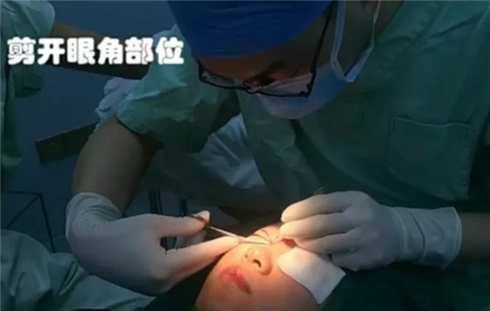 开内眼角手术过程 真人手术步骤图告诉你内眦开大步骤