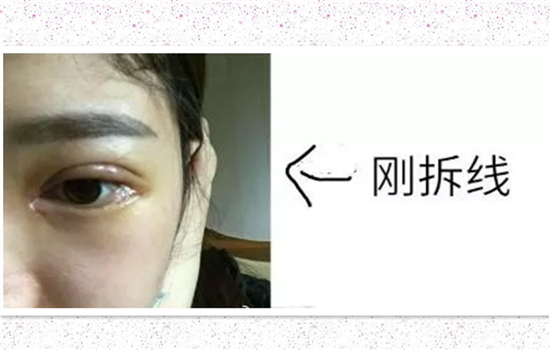 开内眼角一个月恢复图 术后30天初步恢复的样子