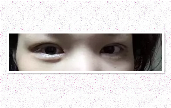 开内眼角一个月恢复图 术后30天初步恢复的样子