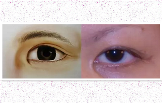 开内眼角眼睛会变大吗 中度重度开内眼角眼睛改善明显