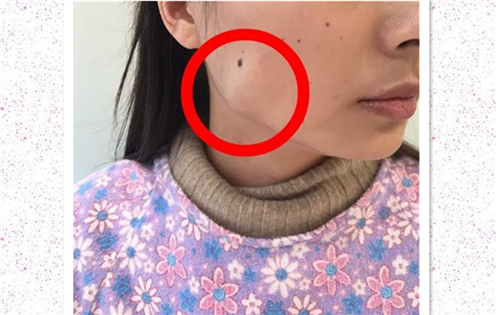 瘦脸针蛙腮怎么处理 及时处理才能避免更大危害